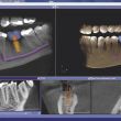 DVT - Planung einer Implantation